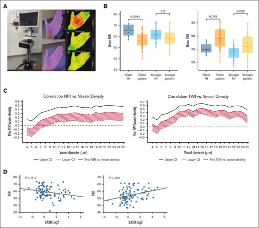 Tivita parameters in HIs and patients, and correlation with GlycoCheck parameters and EASIX. (A) Overview of the Tivita HSI system, including measurement positions (left palm and left fourth fingertip) and representative spectral images showing: (top) Tissue oxygen saturation; (middle) NIR; (bottom) TWI. (B) Box plots comparing age-matched HIs and patients for Tivita parameters (NIR and TWI, n = 100). Wilcoxon rank-sum tests were used to assess significance (P values shown). No significant differences were found between younger and older HI subgroups, whereas patients significantly differed from older HI subgroups (NIR, TWI) and younger HI subgroups (TWI). (C) Correlation analyses between GlycoCheck parameters and Tivita measures. (Left) Correlation between vascular density and NIR; (right) correlation between PBR and TWI. Spearman ρ correlation coefficients (red line) with 95% CIs (gray and black lines) are shown by VD (4-25 μm). A correlation was considered significant if the entire CI lay on 1 side of the y-axis. (D) Linear regression analysis between EASIX and Tivita parameters. (Left) Negative correlation between EASIX and NIR (reduced perfusion); (right) positive correlation between EASIX and TWI (increased vascular permeability).