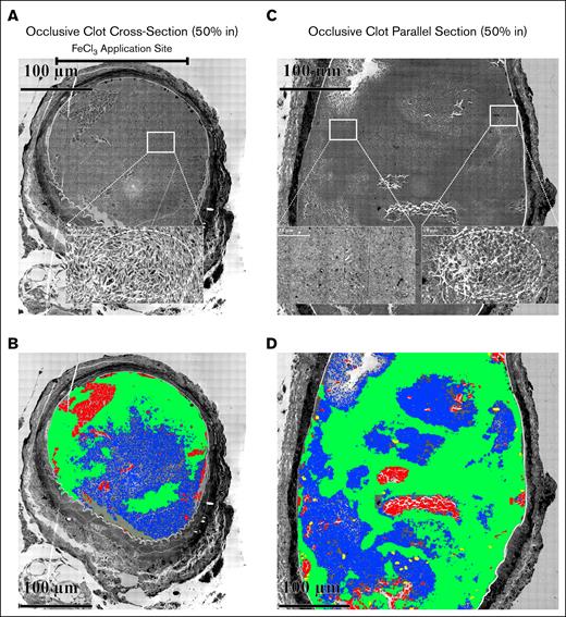 Occlusive clots 20 minutes following FeCl3 treatment. (A) Perpendicular section approximately middle of the thrombus. The upper bar marks the FeCl3 application site. The high-zoomed central section shows the organization of elongated platelets with few pseudopods, mostly discoid in shape and loosely packed spatially. (B) Parallel section approximately middle of the thrombus. The zoomed inset shows elongated platelets with several pseudopods, yet mostly discoid in shape and loosely packed spatially. (B,D) Cloud-based AI analysis of the distribution of clot components (elongated platelets, area of tightly packed platelets, RBCs, and WBCs in both perpendicular and parallel sections within an occlusive clot). Following the training (details of cloud training are given in supplemental Figure 6), 4 files for individual clot components were downloaded. (A-B) The output of training images after applying those on blended images in Arivis Pro software. In panel A, the cellular components were mapped in a perpendicular section, 50% in of an occlusive clot. The trained files for each cellular components were uploaded to the Arivis Pro software, and were applied to the whole blended image using deep learning algorithm through a pipeline. Green, area of tightly packed platelets; blue, elongated platelets; red, RBCs; yellow, WBCs. The upper bar represents the FeCl3 application site. In panel B, the cellular components were mapped in a parallel section, 50% of an occlusive clot in Arivis Pro software using the same algorithm.