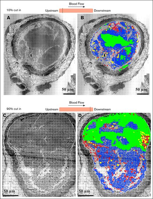 Cloud-based AI analysis of the distribution clot components in perpendicular sections at upper and lower ends within an occlusive clot. The samples are cross-sections cut perpendicular to the blood flow of an occluded femoral artery fixed 20 minutes after FeCl3 application. (A) Upstream end of the clot, 10% in cut. (B) Cloud-based AI analysis of the distribution of clot components at the upper end. Green, area of tightly packed platelets; blue, elongated platelets; red, RBCs; yellow, WBCs. (C) Downstream end of the clot, 90% in cut. (D) Cloud-based AI analysis of the distribution of clot components at the lower end. Green, area of tightly packed platelets; blue, elongated platelets; red, RBCs; yellow, WBCs.