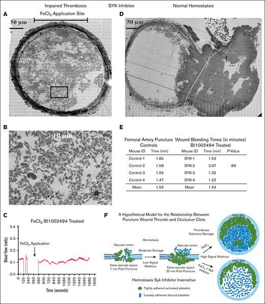 Clot formation in Syk-treated FeCl3 and punctured wound murine model. (A) Perpendicular section approximately middle of a Syk + FeCl3-treated nonocclusive thrombus/sample. (B) A zoomed area from FeCl3-treated nonocclusive thrombus shows a dispersed distribution of elongated platelets leaving large pores in between. (C) Blood flow was monitored and measured with a transit-time perivascular flowmeter and sonic probe. Arrows indicate the timing of FeCl3 treatment. The initial segment was the flow signal detected before FeCl3 treatment. The flow probe signal dropped out as fluid in the vessel’s surroundings was removed to prevent FeCl3 dilution. Fluid was reintroduced upon removal of FeCl3 filter paper, and the flow probe again became functional. Following FeCl3 application, ∼20 minutes of probe flow signal data were collected. No dip in flow signal following treatment indicates no occlusion. (D) Perpendicular section of a Syk-treated punctured model shows a normal clot formation with outer vault consisting of highly activated and tightly packed platelets, while inner crowning consists of elongated, mostly discoid, and loosely packed platelets. (E) The table shows comparison of bleeding time in punctured wound femoral artery model between controls and Syk (BI 1002494)–treated mice. The P value is from a Student t test comparison of the mean bleeding times for control and BI 1002494–treated samples. (F) Cartoon model of proposed relationship between femoral puncture thrombus and an occlusive clot.