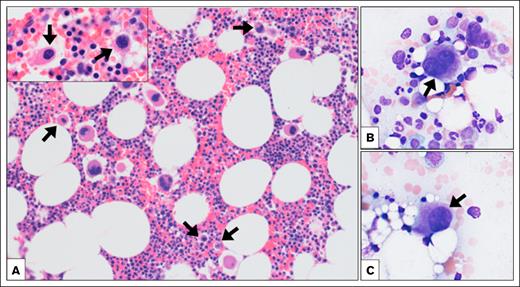 BM biopsy findings. The hematoxylin and eosin–stained BM core biopsy (A, original magnification ×200; inset original magnification ×1000) and Wright-stained aspirate smears (B-C, original magnification ×400) showed trilineage hematopoiesis. Megakaryocytes showed a range of morphologies, including atypical small hypolobated forms (arrows).