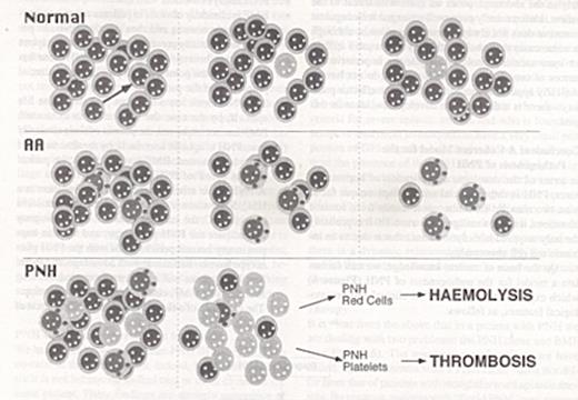 Figure 6. The role of somatic mutation and auto-immune mediated bone marrow failure in the pathophysiology of PNH. . / The top panel is a cartoon of normal hematopoietic stem cells (HSC): the arrow indicates a somatic mutation in the PIG-A gene in one of the HSC. As a result, the cell and its progeny lose surface GPI-anchored proteins. As time goes on, micro clones arising from such mutant cells may become exhausted, and new ones may arise: however, there is no clonal expansion. The middle panel illustrates the presence in the bone marrow of auto reactive immune cells, which may be cytotoxic T cells: these attack the HSC, which gradually decrease in numbers, eventually resulting in the picture of aplastic anemia (AA). The bottom panel illustrates the consequences of the co-existence of a PIG-A somatic mutation and autoreactive immune cells in the bone marrow. If we make the specific hypothesis that the target of the autoimmune attack is a GPI-anchored protein, the mutant clone will expand as a result of negative selection against the normal HSC. As a result, the majority of hematopoiesis will consist of GPI-anchored protein deficient cells. The large numbers of c-susceptible red cells will cause hemolytic anemia; the large numbers of abnormal platelets will cause a high risk of thrombotic complications.