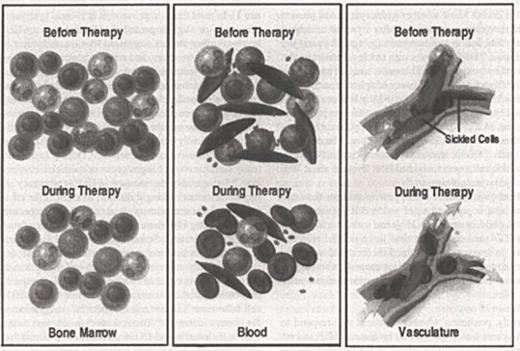 Figure 1. Mechanisms of action of hydroxyurea. . / Hydroxyurea acts on the bone marrow and, by its cytotoxic effects, selects a population of erythroblasts that can synthesize increased amounts of HbF. It has no known direct effects on gene expression. Bone marrow cellularity may also be diminished (left). Higher concentrations of HbF reduce the level of HbS polymer and the numbers of deformed, dense, and damaged erythrocytes. Cells with a high HbF content survive longer, attenuating hemolysis and leading to a reduction in reticulocytes. Circulating granulocytes, monocytes, and platelets are diminished (center). Fewer dense, poorly adhesive erythrocytes are less apt to adhere to and perturb the endothelium, reducing the likelihood of vasoocclusion (right).125