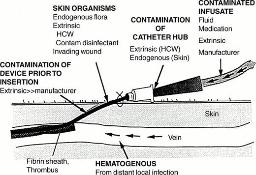 Figure 2. Sources of infection of a percutaneous intravascular device. The major sources are the skin flora, contamination of the catheter hub, contamination of infusate, and hematogenous colonization of the intravascular device and its fibronectin-fibrin sheath from distant, unrelated sites of infection.1