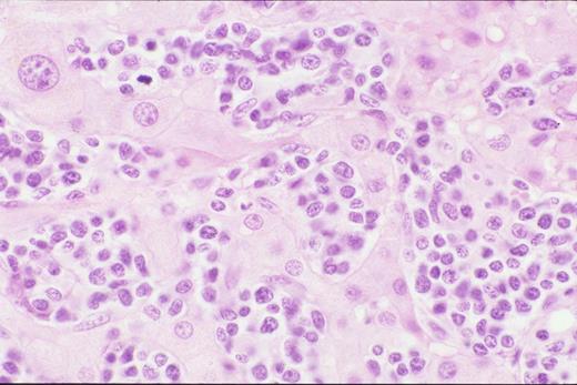 Kinney Figure 1 (Greer et al). Biopsy of liver shows characteristic sinus infiltration by a uniform population of medium-sized lymphocytes with partially dispersed chromatin and little cytologic dysplasia, typical of hepatosplenic T-cell lymphoma.
