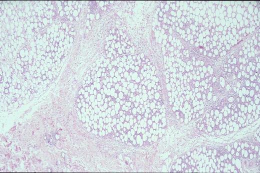 Kinney Figure 2a (Greer et al). At low magnification, this skin biopsy shows a lobular, lacelike pattern of infiltration of the subcutaneous tissue by subcutaneous panniculitis-like T-cell lymphoma. / Kinney Figure 2b (Greer et al). The lymphocytes have irregular, dysplastic , hyperchromatic nuclei and rim the fat spaces. Focal necrosis and cytophagocytosis of cellular elements by benign histiocytes is present.