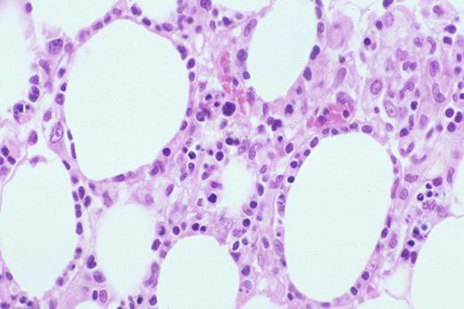 Kinney Figure 2a (Greer et al). At low magnification, this skin biopsy shows a lobular, lacelike pattern of infiltration of the subcutaneous tissue by subcutaneous panniculitis-like T-cell lymphoma. / Kinney Figure 2b (Greer et al). The lymphocytes have irregular, dysplastic , hyperchromatic nuclei and rim the fat spaces. Focal necrosis and cytophagocytosis of cellular elements by benign histiocytes is present.