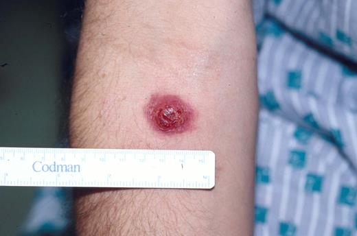 Kinney Figure 3a (Greer et al). Typical clinical appearance of primary cutaneous ALCL with a large ulcerated mass on the arm.
