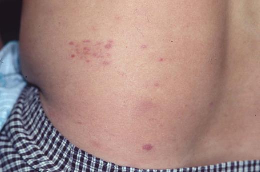 Kinney Figure 3b (Greer et al). Clinical appearance of lymphomatoid papulosis with multiple small crops of papules on the back that spontaneously regress.