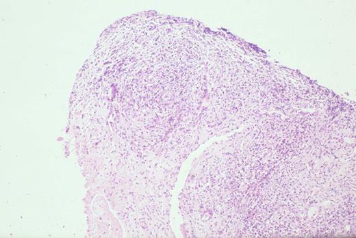 Kinney Figure 4a (Greer et al). Nasal biopsy from a nasal NK/T cell tumor shows zonal necrosis due to an angioinvasive/angiodestructive lymphoid infiltrate. / Kinney Figure 4b (Greer et al). The lymphocytes within the vessel are medium to large with dysplastic, folded nuclei with condensed or dispersed chromatin.