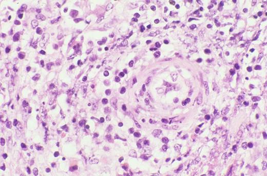 Kinney Figure 4a (Greer et al). Nasal biopsy from a nasal NK/T cell tumor shows zonal necrosis due to an angioinvasive/angiodestructive lymphoid infiltrate. / Kinney Figure 4b (Greer et al). The lymphocytes within the vessel are medium to large with dysplastic, folded nuclei with condensed or dispersed chromatin.