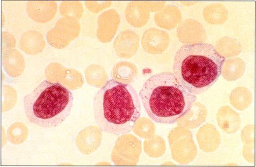 Loughran Figure 5 (Greer et al). Peripheral blood smear in a patient with LGL leukemia shows the characteristic morphology of large granular lymphocytes: They are larger than normal lymphocytes; they have a relatively large amount of cytoplasm; and they contain azurophilic cytoplasmic granules. / (Photo courtesy of Bruce Cheson, National Cancer Institute).