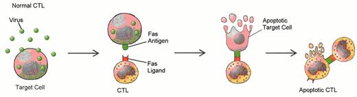 Loughran Figure 6 (Greer et al). Defects in programmed call death (apoptosis) have been suggested as the cause of lymphoproliferation in T-LGL leukemia. / Normally, viral infection of a target cell leads to upregulation of the Fas antigen (receptor) on the cell surface, while antigen recognition of viral peptide causes upregulation of Fas ligand on cytotoxic T lymphocytes (CTL) (A). Binding of Fas ligand to Fas receptor results in death of the viral-infected target cell. The cytotoxic T lymphocyte then upregulates Fas antigen and is itself killed by the effects of Fas binding. Viral infection has been hypothesized as an initial stimulus for LGL leukemia (B). Since LGLs are cytotoxic T lymphocytes, they express both Fas antigen and Fas ligand. In this case, activation of the Fas antigen-Fas ligand pathway is defective. The LGLs do not undergo apoptosis. Instead, leukemic LGLs accumulate in the blood.