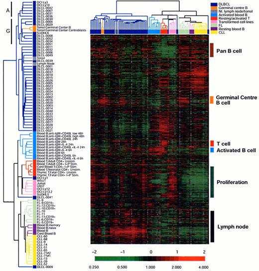 Chan Figure 8 (Harris et al). An example of unsupervised clustering of microarray analysis of normal lymphoid tissues, cell lines and lymphoid malignancies. / The dendrogram on the left is an enlargement of the one on top of the expression data matrix. Note that the dendrogram cluster cases according to their similarity of gene expression pattern and the CLL, FL and DLBCL cases are largely in three clusters. Also note the expression data matrix with the red and green color indicating over and under expressed genes respectively compared with the standard RNA pool. Figure reprinted with permission from Nature (Nature 403:503-511,2000)