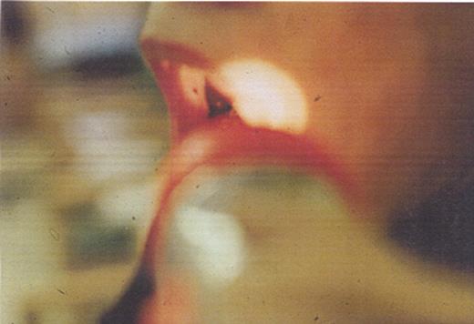 Bussel Figure 1 (McCrae et al). Wet purpura in the buccal mucosa of a patient with ITP. This is a sign that the platelet count is < 10,000/μL.