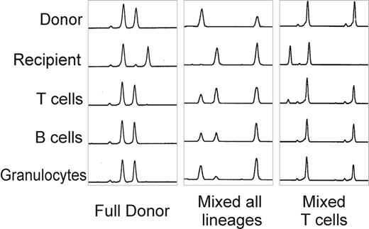 Figure 7. Lineage-specific chimerism analyses from 3 separate patients following reduced-intensity transplantation using microsatellite polymerase chain reaction (PCR). / Three separate patterns of chimerism are shown. The left panel shows full donor chimerism following transplant, the center panel indicates mixed chimerism in all lineages, and the right panel shows mixed chimeras in the T-cell lineage alone.Reprinted with permission from Kottaridis P, Milligan DW, Chopra R, et al. In vivo CAMPATH-1H prevents graft-versus-host disease following nonmyelo-ablative stem cell transplantation. Blood. 2000;96:2419-2425.