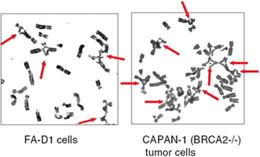 D’Andrea Figure 2 (in D’Andrea et al). Mitomycin C–induced chromosome breaks and radial forms in Fanconi anemia (FA) cells and in BRCA2 (-/-) tumor cells. / The indicated cells were exposed to mitomycin C (40 ng/mL) for 48 hours. Thereafter, the cells were examined for chromosome breakage.
