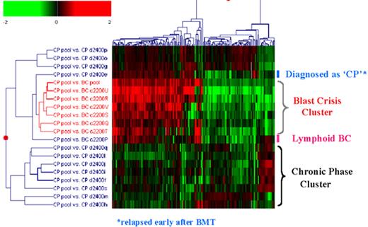 Radich Figure 8 (in Druker et al). Gene expression differences between chronic and blast phase CML. / Figure 8A compares the expression of 25,000 genes between a pool of blast crisis and a pool of chronic phase CML RNA. The Y axis is the relative expression of a gene in blast phase v. chronic phase. The X axis is the intensity of each “spot.” The blue dots represent all genes that are not significantly different between chronic and blast phase. The red dots are genes up-regulated in blast compared to chronic phase (n = 347 genes), and green dots are genes down-regulated in blast compared to chronic phase (n = 203 genes). Figure 8B is a “dendrogram,” which demonstrates the clustering of genes and disease states. Blast crisis cases tend to have gene expression patterns quite similar to other blast crisis cases, but different than chronic phase cases, whose patterns are also fairly similar to one another. Note that a patient with the diagnosis of chronic phase demonstrated a blast crisis gene expression pattern. This patient relapsed early after transplantation.