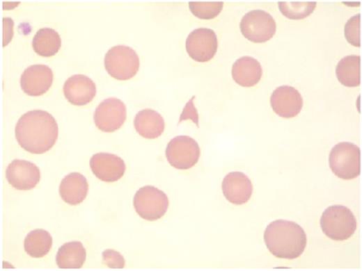 Hambleton Figure 4. The presence of schistocytes on peripheral blood smear suggests the diagnosis of microangiopathy. / Courtesy of Dr Timothy Hamill, Department of Laboratory Medicine, University of California, San Francisco.