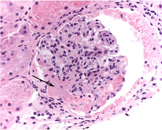 Hambleton Figure 5. Light micrograph of a glomerulus with fibrin-platelet thrombus in afferent arteriole (arrow) as it enters the glomerulus. / Note red blood cell fragments within thrombus (H&E). / Courtesy of Dr. Jean Olson, Department of Pathology, University of California, San Francisco.