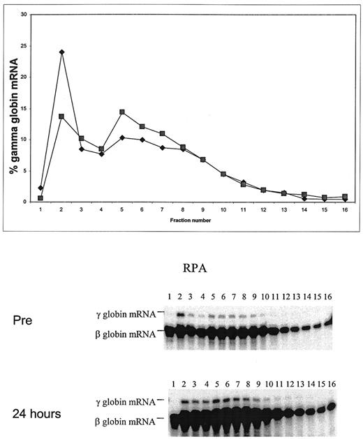 Figure 3. Alteration in the polysomal distribution of γ-globin mRNA in reticulocytes as a result of butyrate therapy. / Analysis of γ-globin mRNA from reticulocytes from a representative butyrate responsive sickle cell disease patients (⧫) Before therapy; (▪) 24 hours after therapy. Fractions 1 and 2 are the pre-polysomal region. Fractions 5 to 8 represent the 1 to 3 ribosomal region.