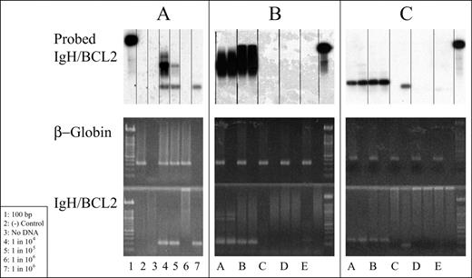 Figure 2. An example of nested polymerase chain reaction (PCR) analysis for detection of minimal residual disease (MRD) in marrows from 2 follicular lymphoma (FL) patients. / Each sample is subjected to PCR for β-globin housekeeping gene and IgH/BCL2; PCR products undergo gel electrophoresis and (+) bands are detected by ethidium bromide staining (center gels = β-globin and bottom gels = IgH/BCL2 MBR). A band is seen only if an appropriate product is detected; specificity of bands is confirmed by Southern blot using BCL2 probe (top autoradiographs). / (Panel A): Multiple controls are run in parallel with patient samples (see box insert). (+) controls are serial dilutions of an IgH/BCL2 (+) cell line (lanes 4–7). The 106 dilution is run twice; as shown, a (+) result is often detected in only 1of these samples at the lower limit of analytical test sensitivity. / (Panels B andC): Parallel PCR analyses of 5 sequential marrows from 2 different FL patients are shown. For each patient, sample A was at diagnosis, before any treatment, B was 1–2 months after completion of CHOP chemotherapy but before treatment with anti-CD20 monoclonal antibody, and marrows C, D, and E were obtained at 2 months, 6 months, and 12 months after CD20 therapy. PCR of all clinical samples is run in duplicate. The patient in Panel B has a (+) nested PCR for IgH/BCL2 MBR at diagnosis and after CHOP, but the marrow becomes PCR (–) by 2 months after CD20 therapy and remains (–) at 6 and 12 months. The patient in Panel C is also PCR (+) at diagnosis and after CHOP, but also has a (+) band in 1 lane at 2 months after CD20 therapy. The (+) band is confirmed to represent a benign IgH/BCL2-carrying cell, not MRD, as it is not present in the duplicate sample and is clearly a different size from the patient’s FL clone. Note that results are more easily interpreted on the BCL2-probed Southern blots than on the ethidium bromide–stained gels.