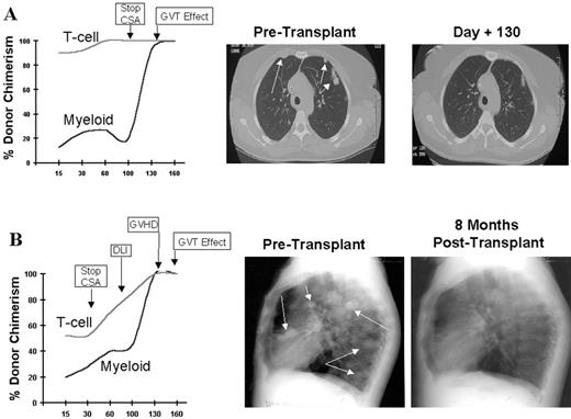 Figure 10. Engraftment profiles and clinical outcome in two renal cell carcinoma (RCC) patients with a delayed graft-versus-tumor (GVT) effect after nonmyeloablative transplantation. / Patient A had a delayed GVT effect in the absence of acute or chronic graft-versus-host disease (GVHD), while patient B had disease regression following a donor lymphocyte infusion (DLI) in association with acute GVHD. / Abbreviations: CSA, cyclosporine.