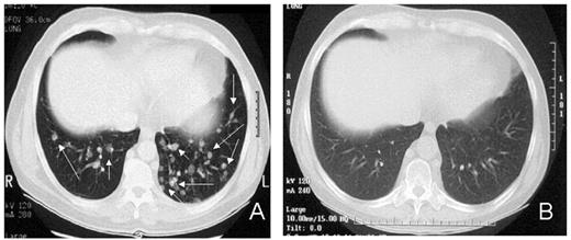 Figure 9. Delayed regression of metastatic renal cell carcinoma (RCC) following a nonmyeloablative transplant. / A) Extensive metastatic renal cell carcinoma (clear cell histology) involving the lungs had grown slightly 1 month after a nonmyeloablative transplant. B) Complete regression of metastatic disease following cyclosporine withdrawal 4 months after transplantation consistent with a graft-versus-tumor (GVT) effect. Disease remission is ongoing more than 5 years after the transplant.
