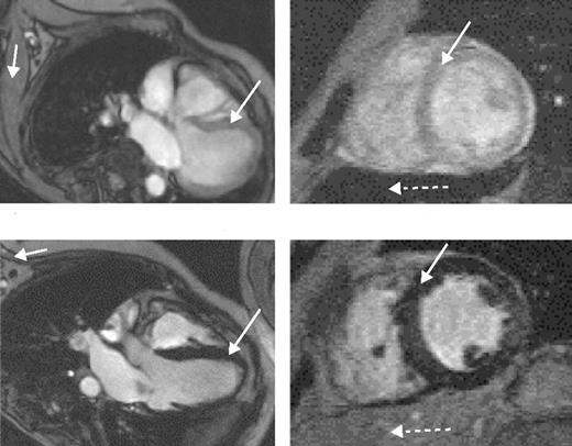Figure 5. Magnetic resonance scans in patients with thalassemia major.Left scans are horizontal long axis, the right ones mid-short axis. (A) Low myocardial iron deposition. The left ventricular volumes are normal, and myocardial signal intensity (long arrow) is similar to that arising from skeletal muscle (short arrow). Left ventricular ejection fraction was 70%. In this case, the liver is very dark (dotted arrow), indicating heavy hepatic iron deposition despite the normal myocardial appearances. (B) Severe myocardial iron overload. The myocardial signal intensity is dark (long arrow) compared with skeletal muscle (short arrow). The ventricle is dilated and thickened. Cine imaging showed greatly reduced systolic function (left ventricular ejection fraction 39%) with a restrictive filling pattern. Liver signal in this case is well preserved (dotted arrow). / Reproduced with permission from Anderson LJ, Wonke N, Prescott E, et al. Improved myocardial iron levels and ventricular function with oral deferiprone compared with subcutaneous desferrioxamine in thalassaemia. Lancet. 2002;360:516–520..9