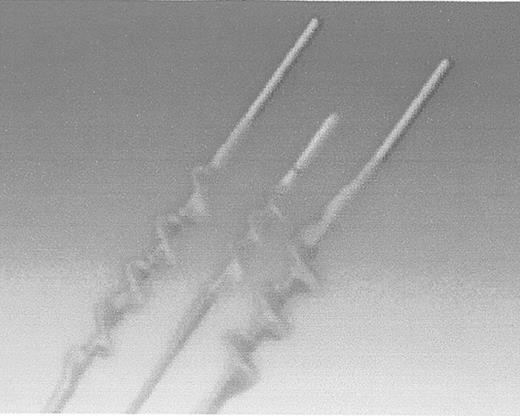 Figure 4. Edwards Lifesciences Fogarty Adherent Clot Catheter. / Inner wire loop is protected by outer latex covering. Catheter is used for arterial and graft occlusions.