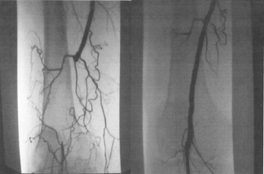 Figure 6. Occluded popliteal artery, before (A) and after (B) laser-assisted balloon angioplasty.