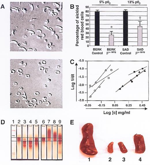 Nagel Figure 7. (in Atweh et al). Correction of sickle cell pathology by T87Q-globin containing lentivirus-transduced BERK and SAD marrow. / Nomarski optics microscopy of red cells from mice transplanted with either (top) mock- or (bottom) T87Q-globin lentivirus-transduced BERK bone marrow cells under 5% pO2 3 months after transplantation. / Quantification of the percentage of sickle red cells from recipients of mock-transduced and T87Q-globin transduced BERK or SAD bone marrow under 5% or 13% oxygen conditions, respectively.43 Error bars indicate SE; *, P = .01; †, P = .03. / Relationship between log of reciprocal delay time of HbS polymerization and Hb concentration of red cell lysates. / Time courses of Hb polymerization in lysates were performed at various concentrations by the temperature jump method: open triangle: a mouse recipient of mock-transduced SAD marrow; close square, lysate from a mouse recipient of bT87Q-globin transduced SAD marrow; open circle, a mouse recipient of mock-transduced BERK marrow; closed circle, a mou se recipient of bT87Q-globin transduced BERK marrow. / Reprinted with permission from Pawliuk R, Westerman KA, Fabry ME, et al. Correction of sickle cell disease in transgenic mouse models by gene therapy. Science. 2000;294:2368–71.