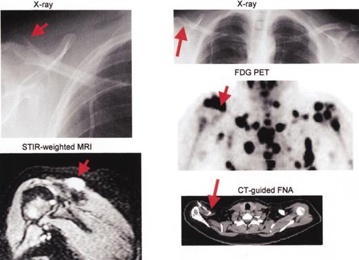 Barlogie Figure 14. Multiple myeloma including large plasmacytoma distal right clavicle (arrows).
