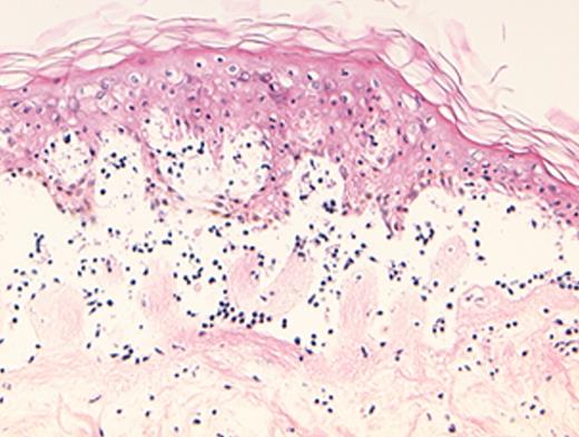Dickinson Figure 2. (in Barrett et al). In situ localization of mHa-specific cytotoxic T lymphocytes (CTLs) in the skin explant assay. / Skin sections of an HLAA2 male individual were incubated with autologous peripheral blood mononuclear cells (PBMCs)—data not shown, or with H-Y- or HA-1-specific CTLs. / Figure 2a. H-Y-specific CTLs showing grade IV reactions. / Figure 2b. Skin sections incubated with FITC-conjugated CD8 antibodies (green) plus APC-conjugated (red) tetrameric HLA-A2-H-Y peptide complex (H-YA2 tetramer)—analyzed by confocal microscopy. / Figure 2c. Mild histopathological changes induced by HA-1-specific CTLs. / Reprinted with permission of the Nature Publishing Group (http://www.nature.com).44