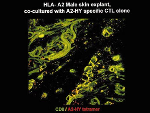 Dickinson Figure 2. (in Barrett et al). In situ localization of mHa-specific cytotoxic T lymphocytes (CTLs) in the skin explant assay. / Skin sections of an HLAA2 male individual were incubated with autologous peripheral blood mononuclear cells (PBMCs)—data not shown, or with H-Y- or HA-1-specific CTLs. / Figure 2a. H-Y-specific CTLs showing grade IV reactions. / Figure 2b. Skin sections incubated with FITC-conjugated CD8 antibodies (green) plus APC-conjugated (red) tetrameric HLA-A2-H-Y peptide complex (H-YA2 tetramer)—analyzed by confocal microscopy. / Figure 2c. Mild histopathological changes induced by HA-1-specific CTLs. / Reprinted with permission of the Nature Publishing Group (http://www.nature.com).44