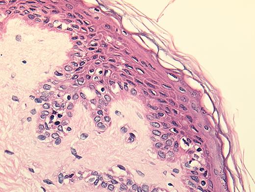 Dickinson Figure 2. (in Barrett et al). In situ localization of mHa-specific cytotoxic T lymphocytes (CTLs) in the skin explant assay. / Skin sections of an HLAA2 male individual were incubated with autologous peripheral blood mononuclear cells (PBMCs)—data not shown, or with H-Y- or HA-1-specific CTLs. / Figure 2a. H-Y-specific CTLs showing grade IV reactions. / Figure 2b. Skin sections incubated with FITC-conjugated CD8 antibodies (green) plus APC-conjugated (red) tetrameric HLA-A2-H-Y peptide complex (H-YA2 tetramer)—analyzed by confocal microscopy. / Figure 2c. Mild histopathological changes induced by HA-1-specific CTLs. / Reprinted with permission of the Nature Publishing Group (http://www.nature.com).44