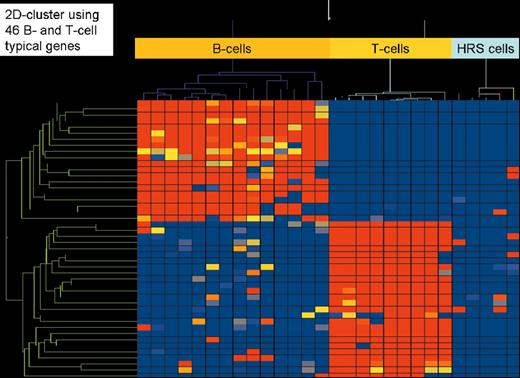 Stein Figure 1. (in Diehl et al). Two-dimensional cluster analysis of 15 B-cell lines, 9 T-cell lines, and 5 classical Hodgkin’s lymphoma cell lines (3 of B-cell type and 2 of T-cell type) employing 46 genes highly characteristic for their expression in all types of B cells (except plasma B cells) and T cells, respectively. High gene expression is indicated in red, low or absent gene expression in blue.