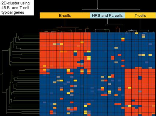 Stein Figure 3. (in Diehl et al). Two-dimensional cluster analysis of the same 15 B-cell lines, 9 T-cell lines, and 5 classical Hodgkin’s lymphoma cell lines using the same 46 highly B-cell and T-cell characteristic genes and the same as in Figure 1. In addition, 5 plasmacytoma cell lines were included to analyze their relation to classical Hodgkin lymphoma cell lines.