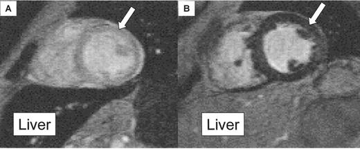 Figure 5. Discordance of liver and myocardial iron. . / In A the patient has heavy liver iron loading (black liver), but the heart retains signal indicating light loading (arrow). If management or myocardial iron were based on a liver biopsy in this patient, chelation treatment might be increased, but the risk of cardiac complications from iron overload is low. In B the patient has little liver iron loading (grey liver), but the heart has low signal indicating heavy loading (arrow). If management or myocardial iron were based on a liver biopsy in this patient, chelation treatment might be maintained at current levels or even decreased, but the risk of cardiac complications from iron overload is high.