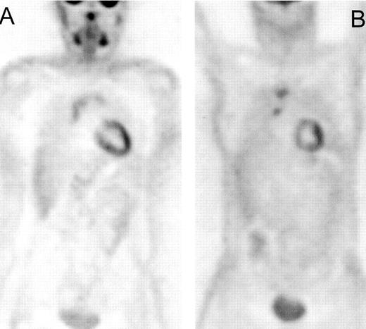 Figure 5. Residual increased fluorodeoxyglucose (FDG) uptake after ABVD therapy in two patients with Hodgkin’s lymphoma. / The typical butterfly-shaped configuration is suggestive for thymic hyperplasia (A), and this patient remained in complete remission after a follow-up of 23 months. The more focal uptake seen in patient (B) is more suspicious for residual tumor, progression in the residual mass was seen 6 months later on CT.