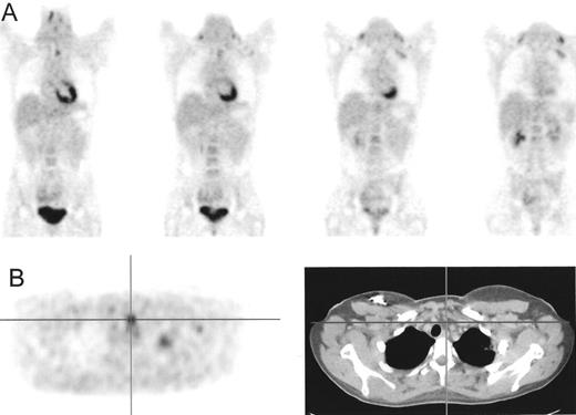 Figure 6. Persistent fluorodeoxyglucose (FDG) uptake in the cervical and mediastinal regions, 3 months after completion of chemo-radiotherapy. / Based on positron emission tomography (PET) alone, no discrimination is possible between residual lymphoma and physiological uptake in muscle and/or brown fat tissue (A). Fusion images located all hot spots to be in brown fat tissue. Based on PET–computed tomography (CT), it was concluded that the patient achieved a complete remission.