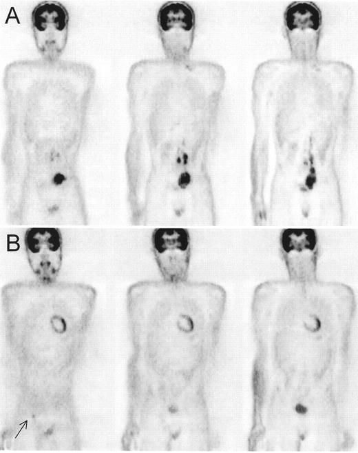 Figure 7. Positron emission tomography (PET) scan of a patient with Hodgkin’s lymphoma, nodular sclerosis, stage IIIB, prior to the start of chemotherapy (A). / PET after therapy (B) showed a complete normalization of the initially involved sites, but a new hot spot developed in the right groin (→). Correlation with clinical history revealed erysipelas of the right leg with probably inflammatory nodes in the groin. Repeat PET scan after antibiotics was completely normal. The patient remains in complete remission after a follow-up of 4 years.