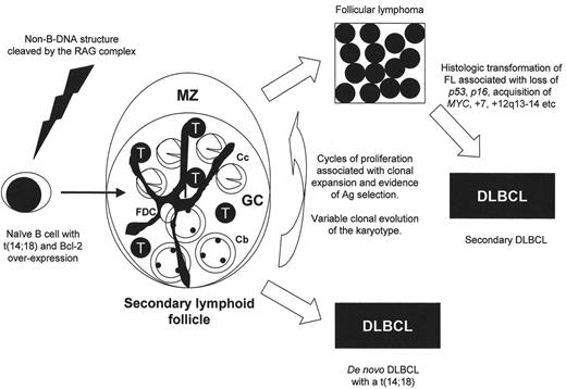 Figure 1. Proposed model for follicular lymphogenesis and diffuse large B cell lymphoma (DLBCL) transformation. / The t(14;18) is a rare event occurring in naïve B cells and likely at a time when the RAG complex is active (primary VDJ recombination). These cells are relatively immortalized resulting from overexpression of the Bcl-2 protein and likely seed lymph nodes and reside within follicles. Without significant clonal evolution and independence, these follicular lympoma (FL) cells may require a microenvironment complete with follicular dendritic cells and reactive T cells. Repeated cycles of proliferation occur (despite the expression of Bcl-2), but at a low rate as is characteristic of follicular lymphoma (FL). With cell divisions the clone expands and secondary cytogenetic alterations occur. If critical cytogenetic events occur early in the evolution of this process, the cells may lose the need for a germinal center (GC) microenvironment and patients may present as de novo DLBCL. Alternatively, patients present with FL characterized by a diverse spectrum of cytogenetic alterations, the majority of which are copy number alterations (chromosomal gains and losses). The presence of FDCs and T cells within the follicle recapitulates the normal secondary follicle, but their presence in FL may be as immune response cells or alternatively, reflect the clonal evolution of the malignant B cells. / Abbreviations: FDC, follicular dendritic cell; GC, germinal center; MZ, mantle zone