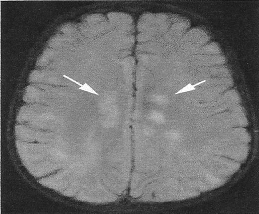 Figure 1. A lesion that mimics silent cerebral infarct (SCI). / High signal intensity lesions in the central white matter of both cerebral hemispheres (white arrows) in a child with acute disseminated encephalomyelitis. SCI often have a similar appearance.