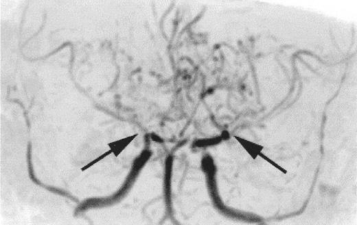Figure 2. Time-of-flight MR angiogram from a child with sickle cell anemia (SCA) and Moya-Moya. / Severe narrowing of the distal internal carotid arteries and proximal middle cerebral arteries (black arrows) is typical of the intracranial vasculopathy seen with SCA. Prominent lenticulostriate collateral vessels produce the Moya-Moya (“puff of smoke”) pattern seen above the stenoses.