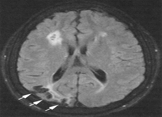 Figure 3. Magnetic resonance imaging (MRI) from a child with sickle cell anemia (SCA) and Moya-Moya. / The severe hemodynamic compromise associated with the Moya-Moya vasculopathy is associated with overt stroke secondary to a right parietal cortical infarction (white arrows). The signal hyperintensities in the frontal regions correspond to silent cerebral infarctions.