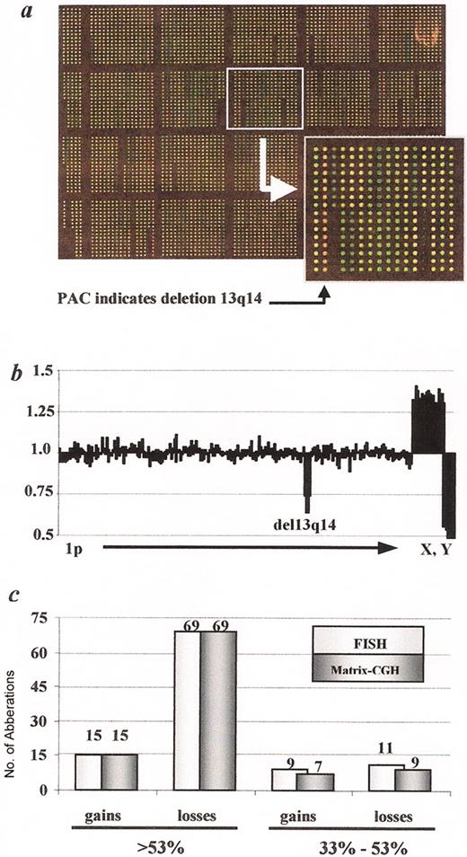 Stilgenbauer Figure 4. (in Byrd et al). Genome-wide diagnosis of genomic aberrations by matrix CGH (Schwänen 2004). / A. Image of a DNA chip after matrix CGH hybridization with DNA derived from a CLL patient carrying a 13q14 deletion (labeled in green; Cy3) versus human control DNA (labeled in red; Cy5). Insert: PAC clone in 13q14 with a dominantly red fluorescence signal after hybridization, indicating the deletion within this region (see arrowhead). / B. Example of a profile of signal ratios arranged in ascending chromosomal order beginning with 1p and ending with the X and Y chromosome. The cluster of fragments detecting deletion within 13q14 is indicated. In addition the gender mismatch (CLL sample: female, control DNA sample: male) is detected by the imbalanced ratio of the X and Y chromosomes. / C. Assessment of the diagnostic power of the matrix CGH chip by comparison with data obtained by FISH with a comprehensive probe set. In 107 CLL displaying a total of 27 gains and 95 losses, all recurrently imbalanced regions were correctly identified, if the proportion of cells carrying the respective gains or losses was larger than 53% as determined by FISH.