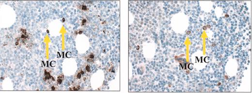 Treon Figure 5. (in Gertz et al). Tryptase staining demonstrating abundant mast cells in a bone marrow clot section taken from a patient with Waldenström’s macroglobulinemia (A); CD40 ligand staining on mast cells from the same clot section (B).