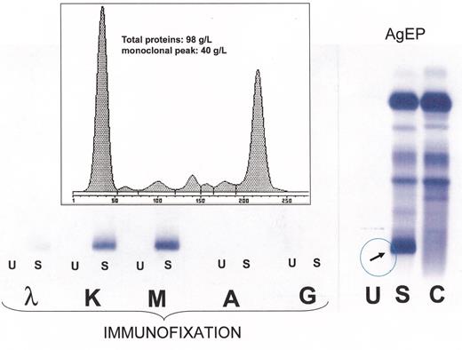 Treon Figure 6. (in Gertz et al). Right: High-resolution agarose gel electrophoresis (AgEP) of control serum (C) and of serum (S) and urine (U) from a patient with Waldenström’s macroglobulinemia (anode above). An important monoclonal component is present in the serum, in the gamma region (arrow). Left: By immunofixation using anti-IgG (G), anti-IgA (A), anti-IgM (M), anti-κ (κ) and anti-λ (λ) antisera the serum monoclonal band is typed as IgMk, while no monoclonal protein is detectable by immunofixation in the urine. Inset: The monoclonal IgMk is quantified by densitometry as being 40 g/L.