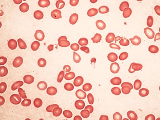 Higgs Figure 4. Typical blood findings in α thalassemia myelodysplasia syndrome (ATMDS). / A. A peripheral blood smear (May-Grünwald-Giemsa, ×400) from an untransfused patient. Many red cells are hypochromic and/or microcytic, while others appear relatively normal and well-preserved, presumably the descendants of non-thalassemic clones. / B. Classic hemoglobin H inclusions (HbH) in an ATMDS patient seen after supravital staining (Brilliant cresyl blue, ×400).